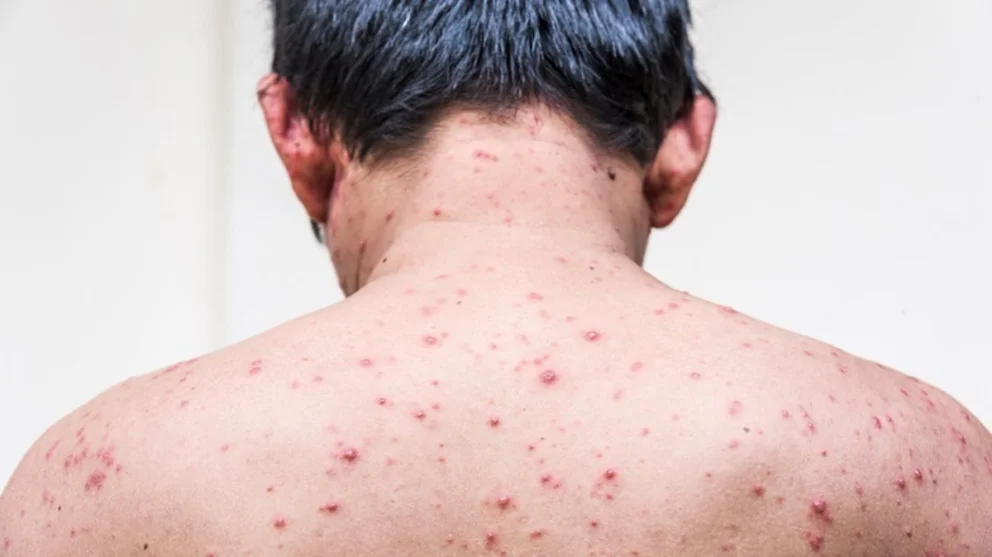 La vacunación es una de las principales herramientas para prevenir la enfermedad. Foto: gentileza.